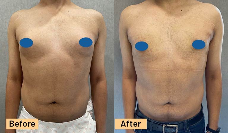 Real Patients – Gynecomastia Surgery