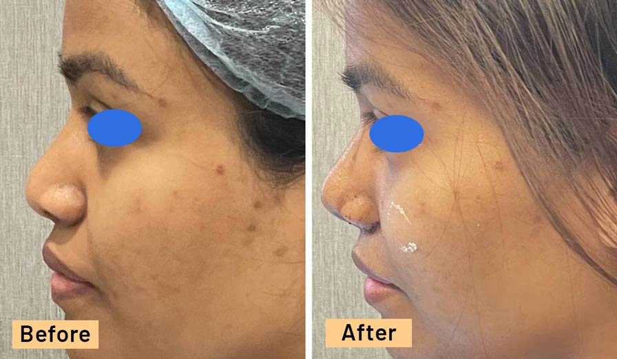 Rhinoplasty Surgery Results