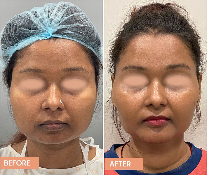 Facial Slimming Surgery Results in Female