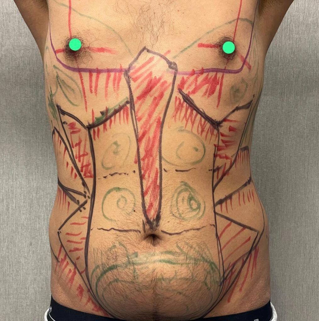 Preoperative markings play a crucial role in cosmetic surgery