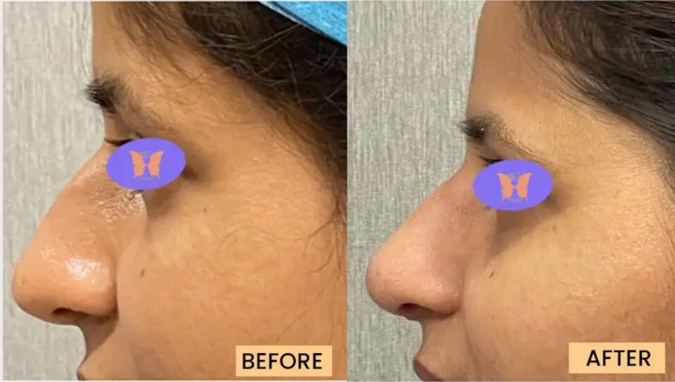 Rhinoplasty Surgery