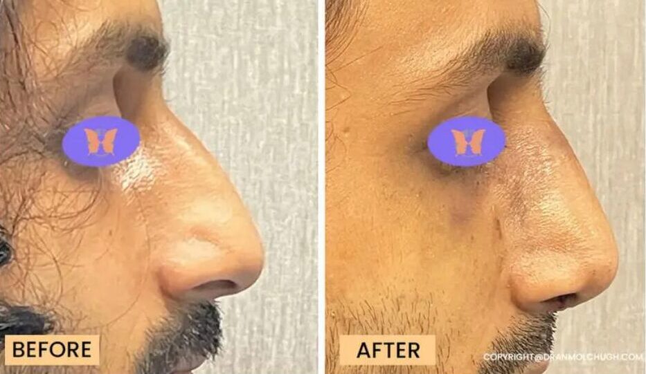 Rhinoplasty Surgery
