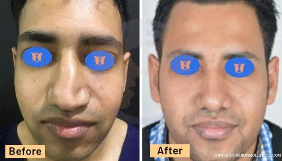 Rhinoplasty Surgery
