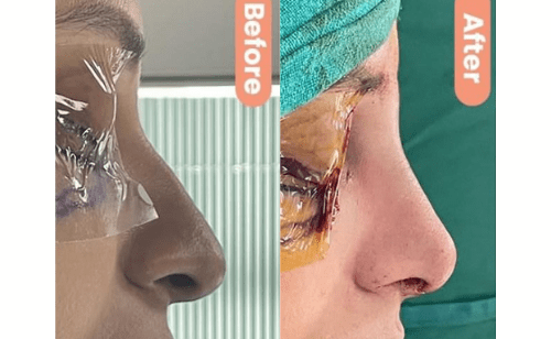 Rhinoplasty Surgery