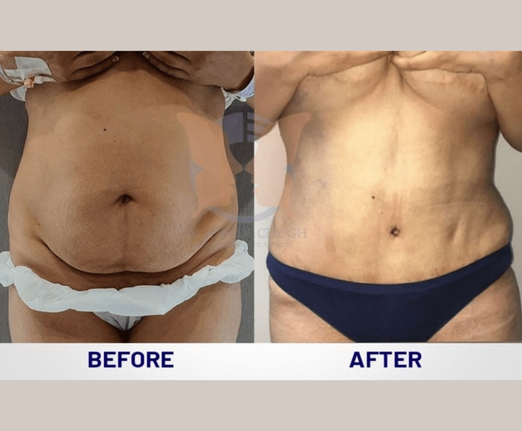 Tummy Tuck