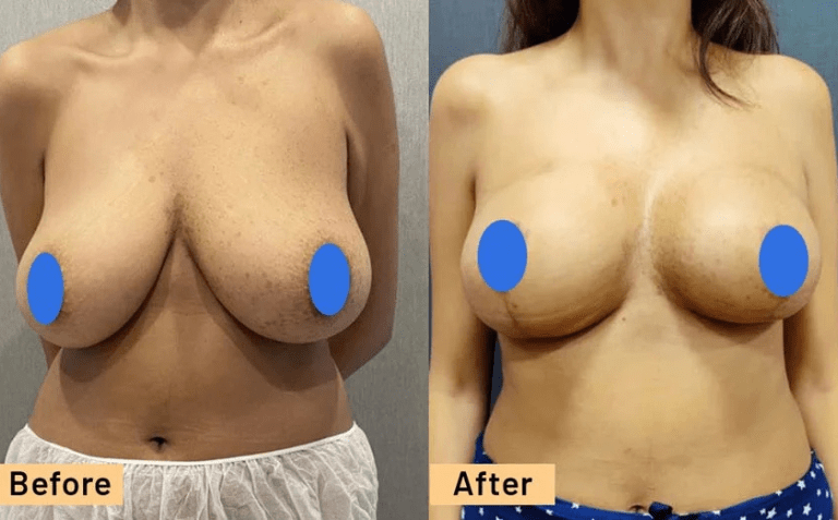Breast Reduction