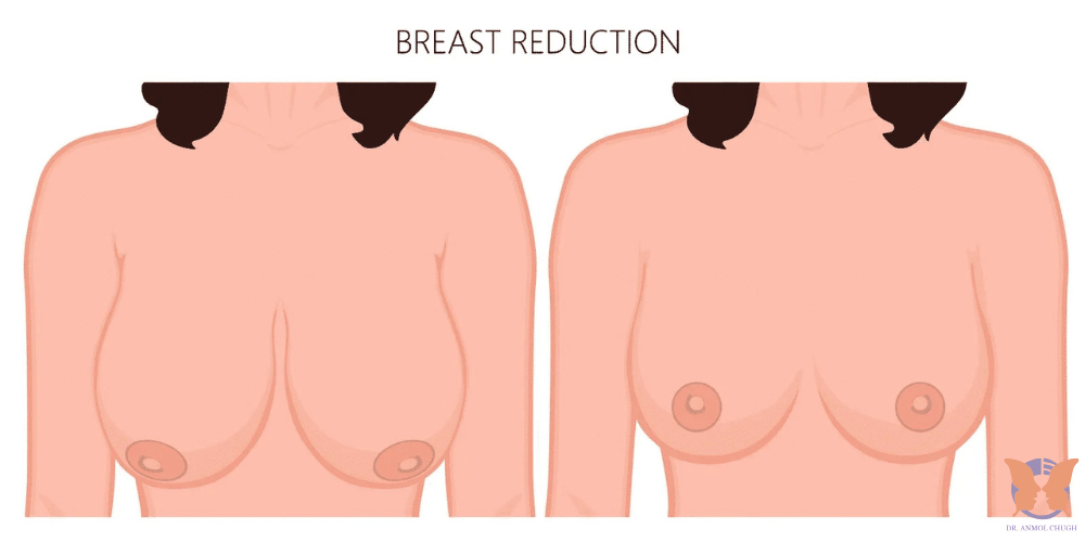 Natural breast reduction results – balanced and proportionate breast shape for enhanced confidence