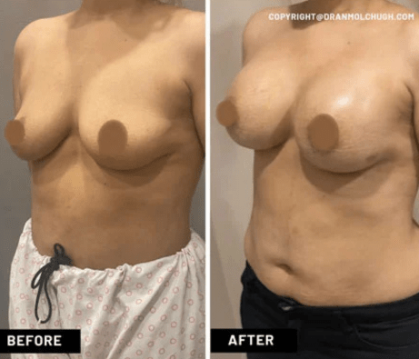 Breast Augmentation with Implants – Case Study for 40 year old female
