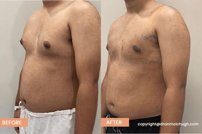 Grade 2 Gynecomastia