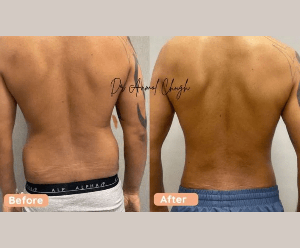 High Definition Liposuction | 40 year old male | 3 months post surgery