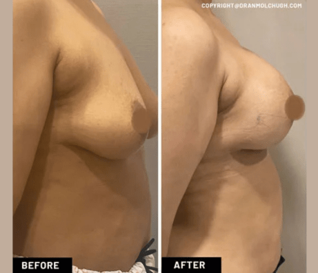 Breast Augmentation