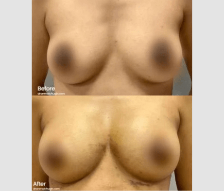 Breast Augmentation