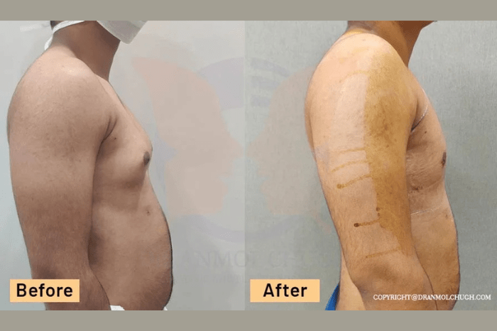 Grade 1 Gynecomastia