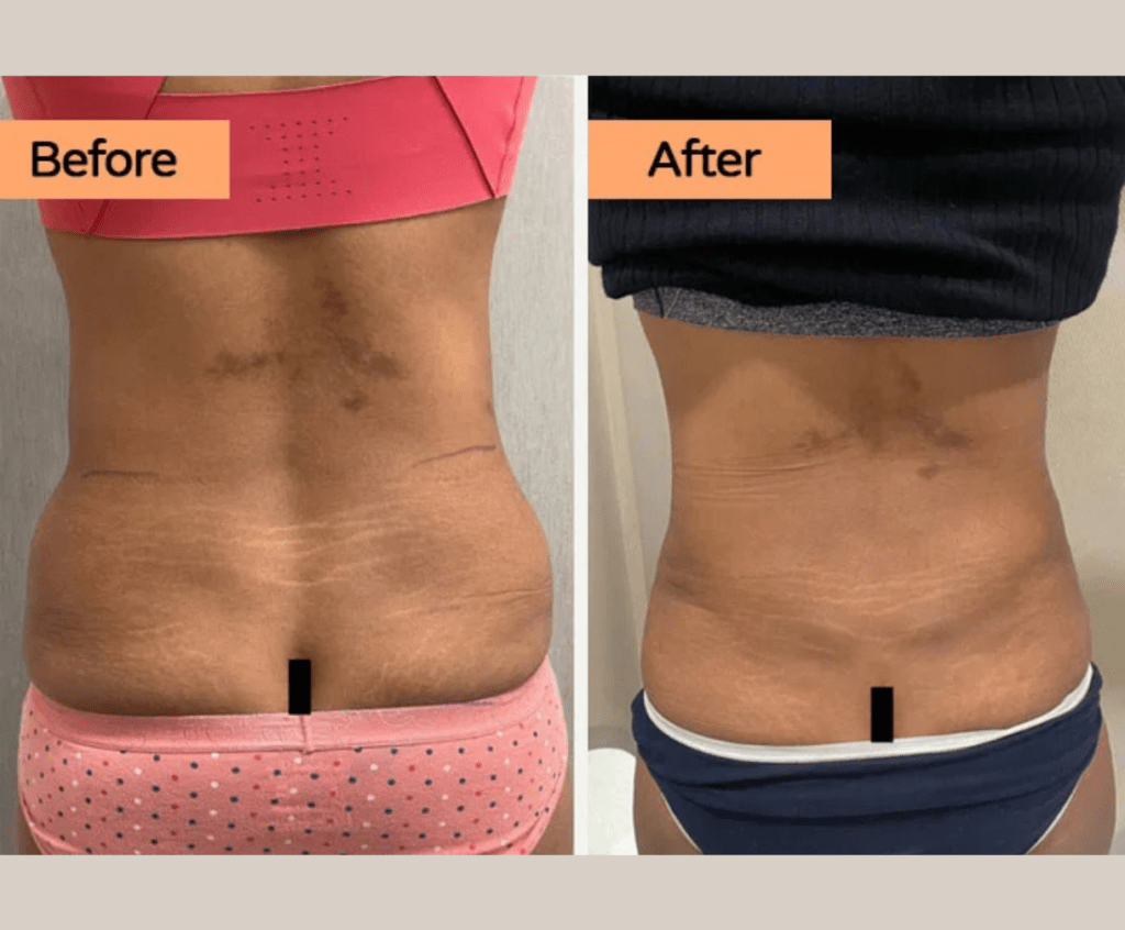 35-44 year old woman treated with Liposuction