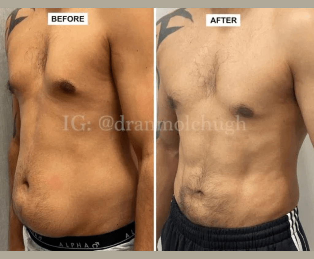 40 year old male, 6 months post surgery, Hi-definition Liposuction
