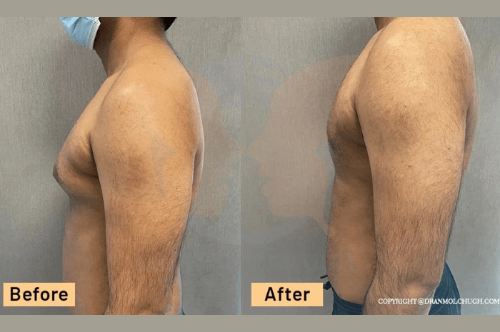 Grade 3 Gynecomastia