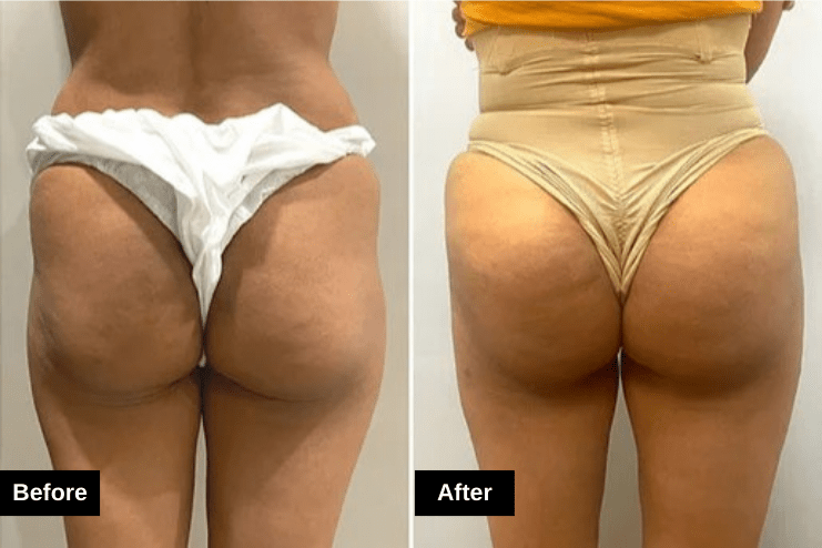 Brazilian Butt Lift