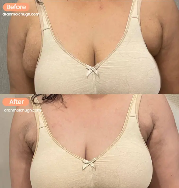 Axillary breast fat removal
