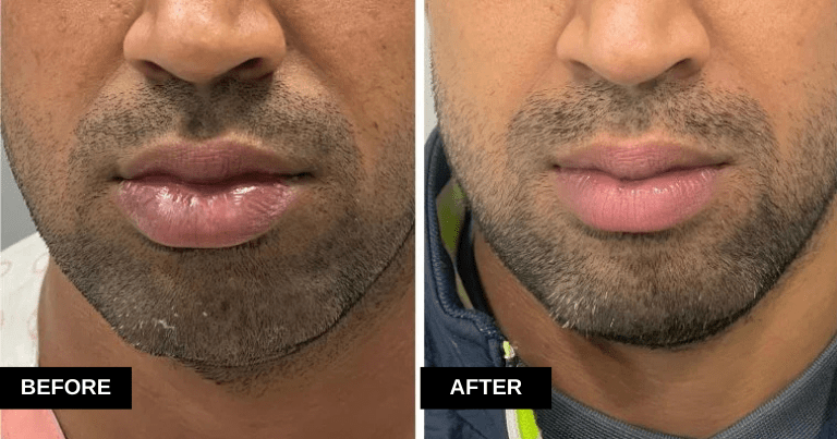 Lower Lip Reduction, 28yr/M, 1 Month Post Op