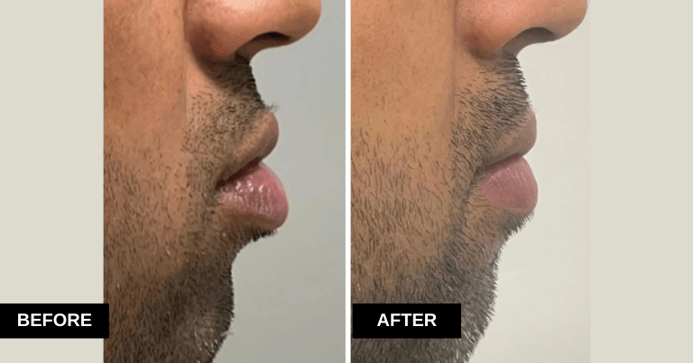 Lower Lip Reduction, 28yr/M, 1 Month Post Op
