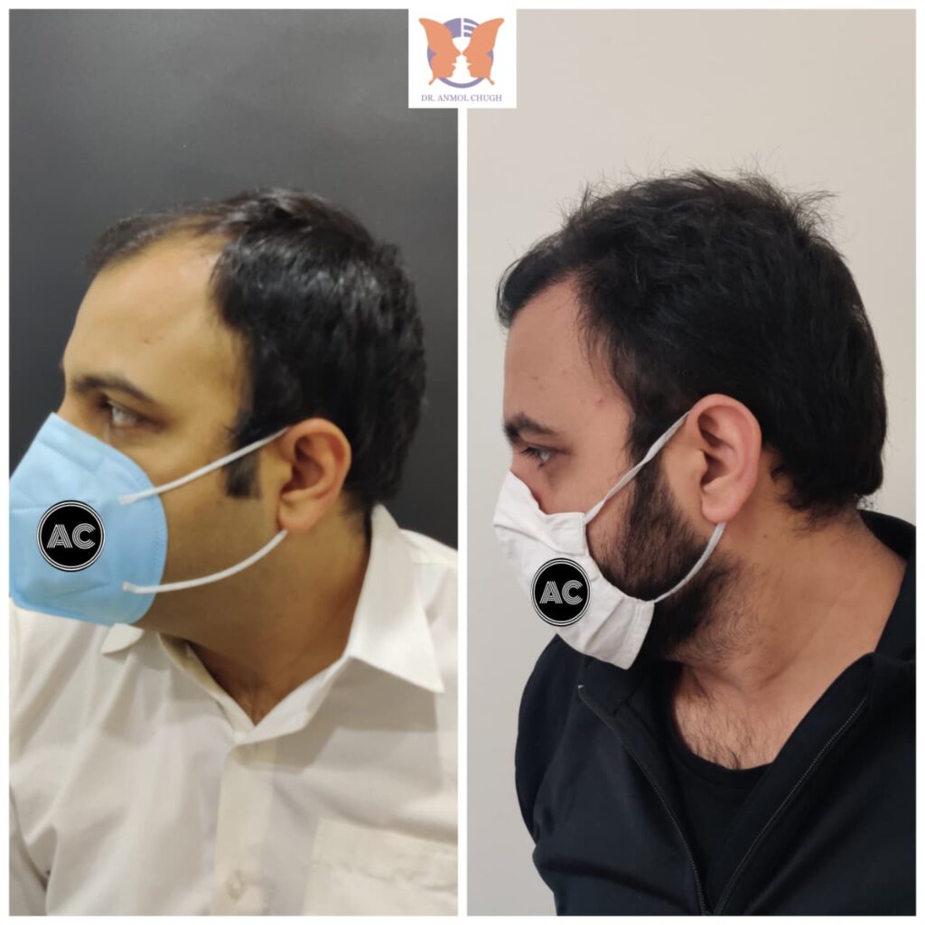 Hair Transplant Patient Result 1