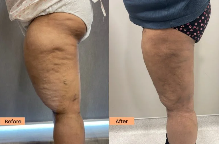 Lipedema 6 weeks post op 40-year-old female