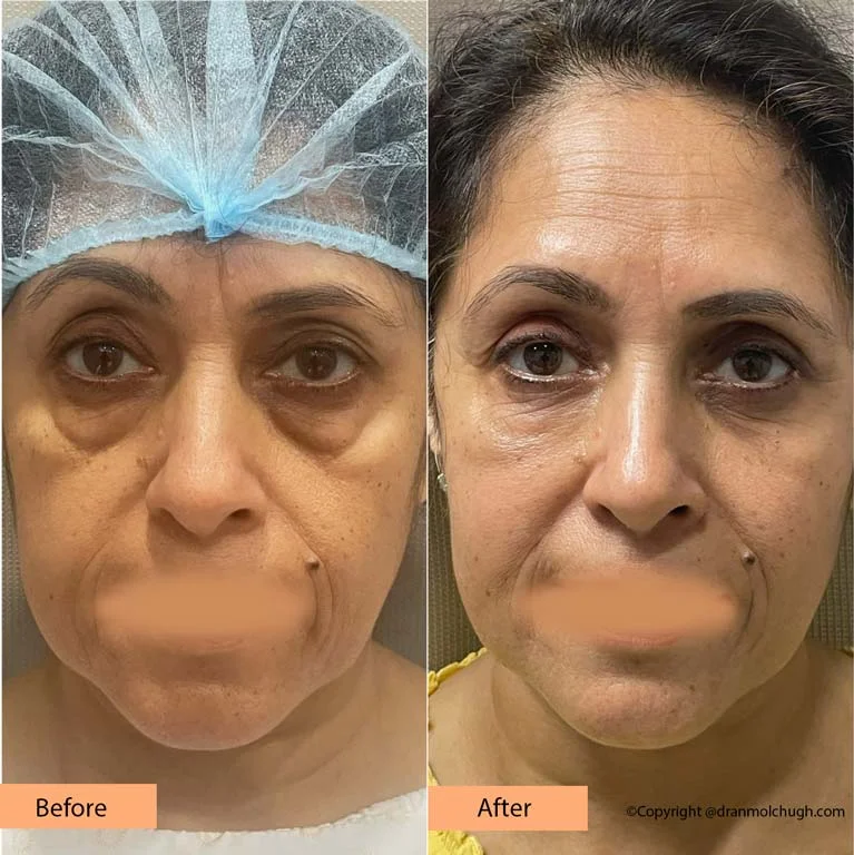 58 year old female, Upper and Lower Blepharoplasty – One month postop