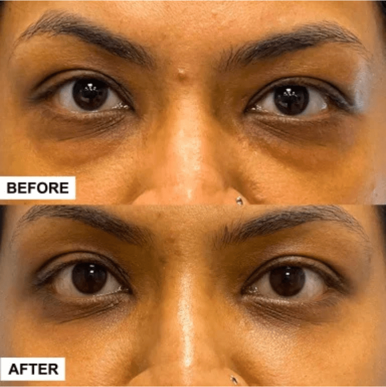 34 year old female, 6 months Post Op