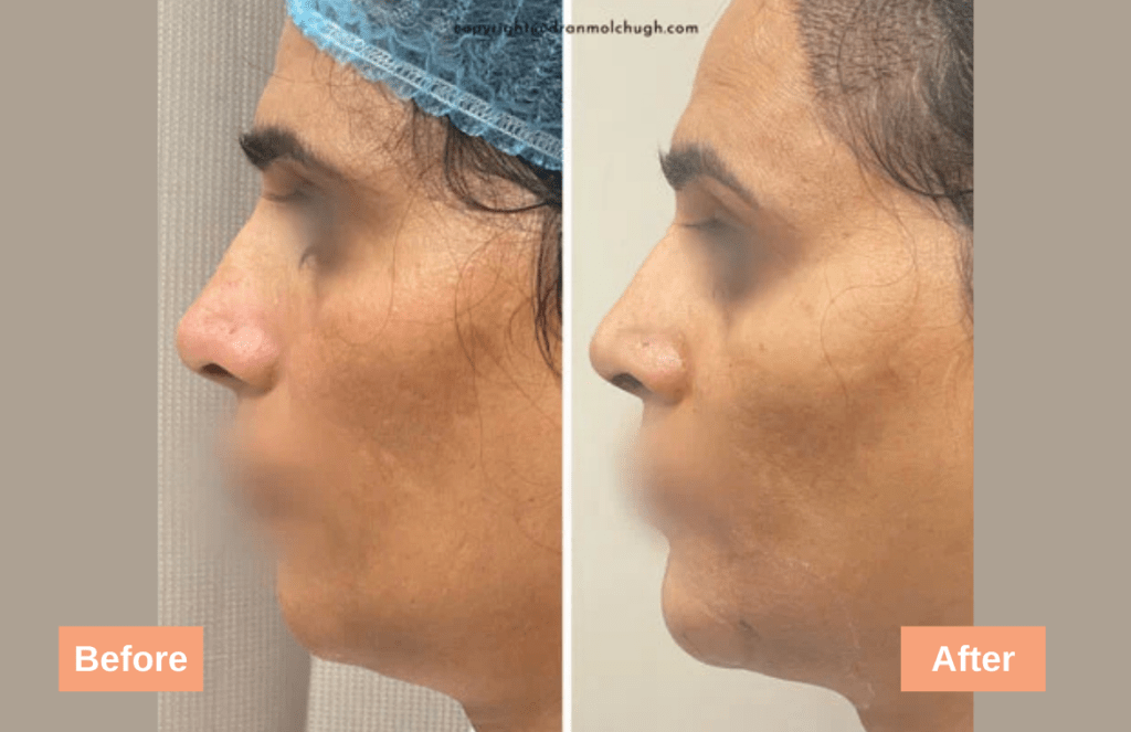 Chin Implant