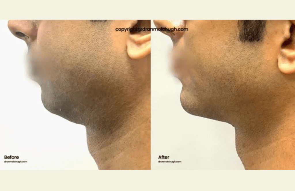 Chin Implant
