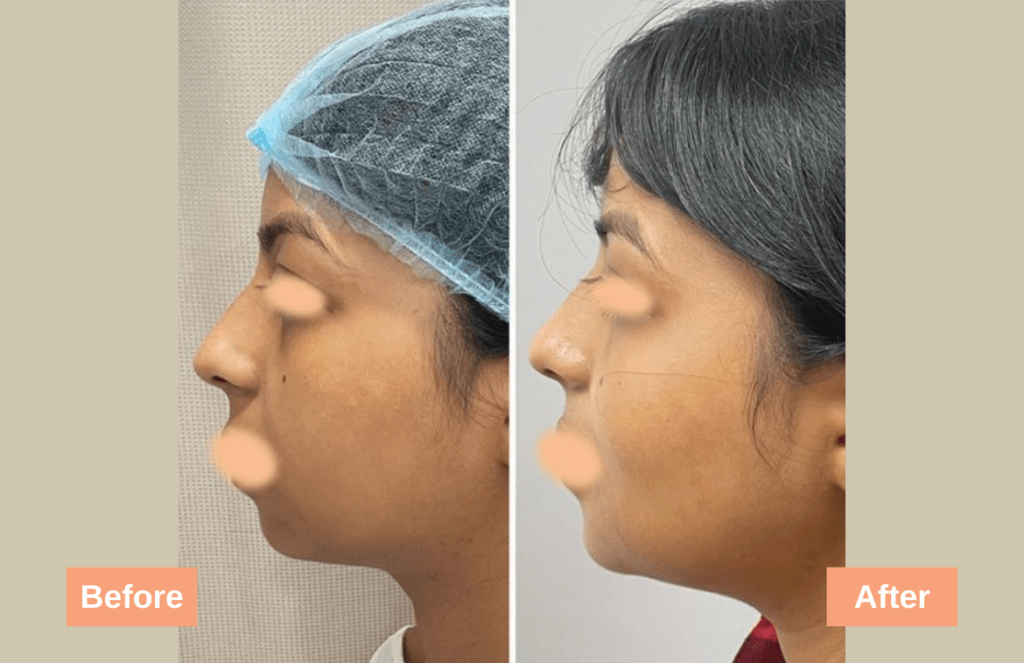 Chin Implant